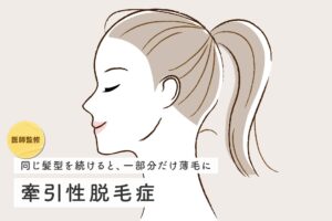 【医師監修】牽引性脱毛症は治るのか、対策や治療法、自然治癒についても解説